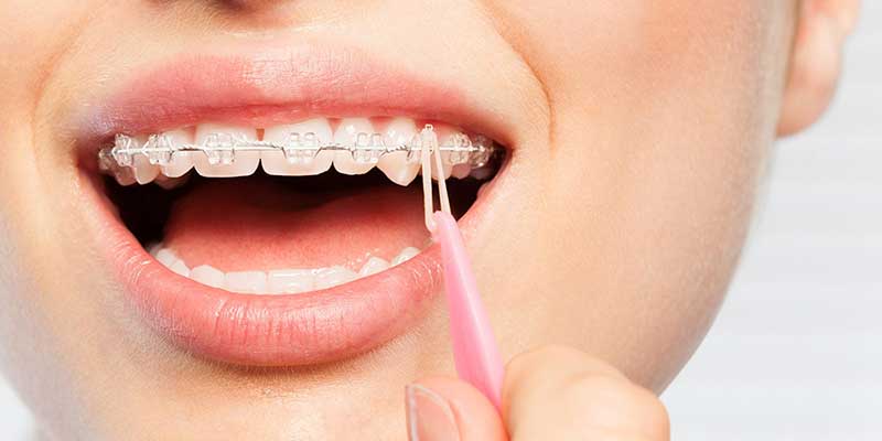 ارتودنسی ثابت دندان