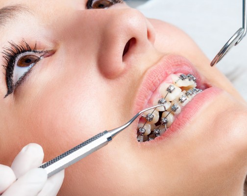 هزینه های ارتودنسی دندان