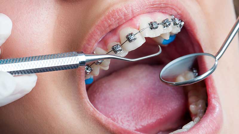 هزینه های ارتودنسی دندان