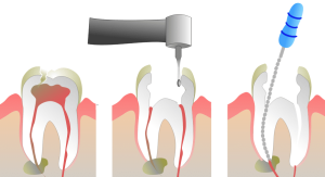 مراقبت از عصب کشی دندان
