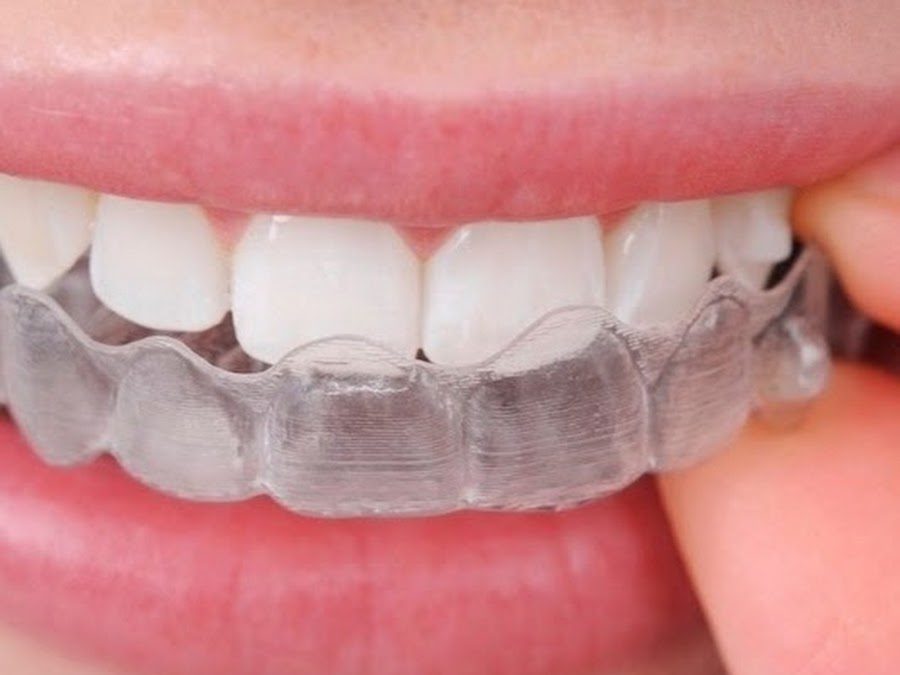 Advantages and disadvantages of invisible orthodontics