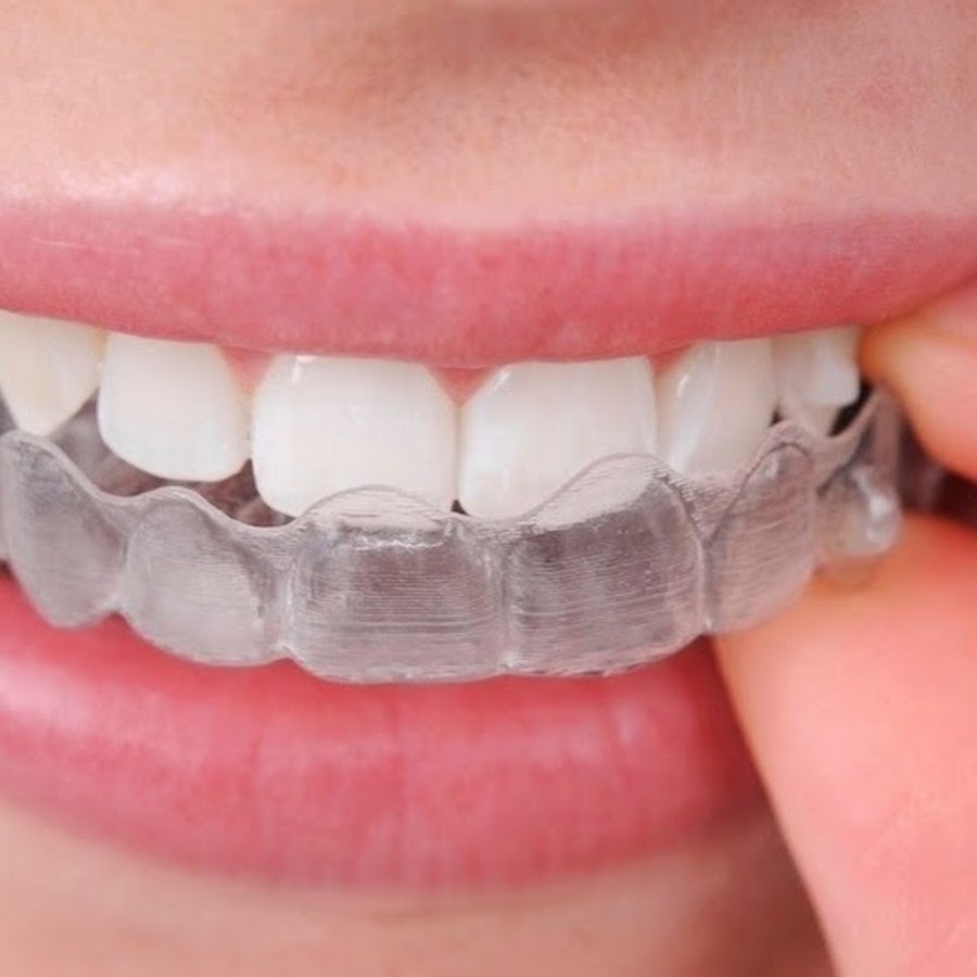 Advantages and disadvantages of invisible orthodontics