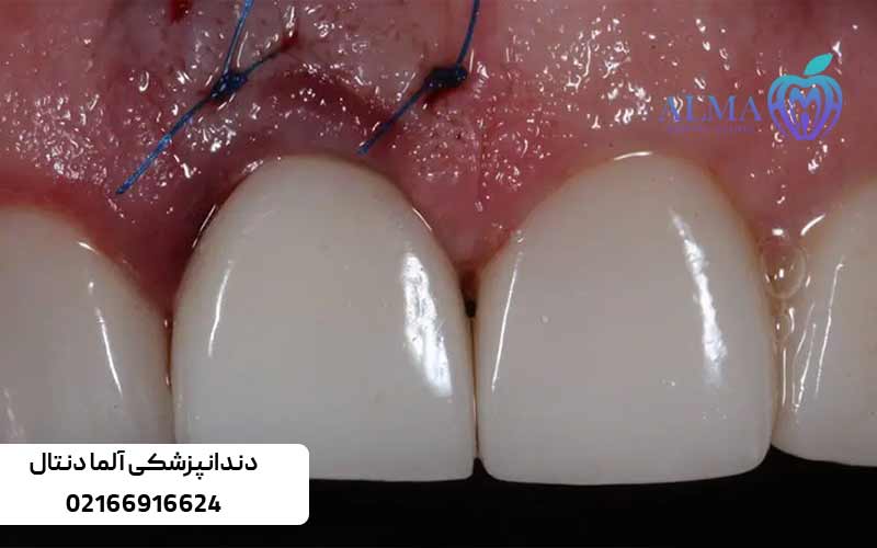 عواما-موثر-بر-مدت-زمان-ایمپلنت-دندان