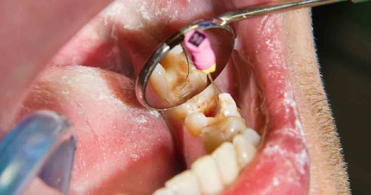 علائم به عصب رسیدن دندان