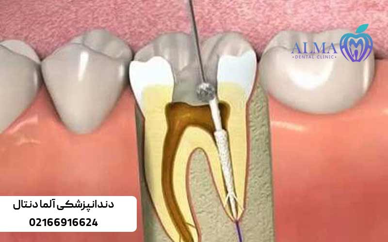دلیل-اصلی-برای-درد-عصب-دندان