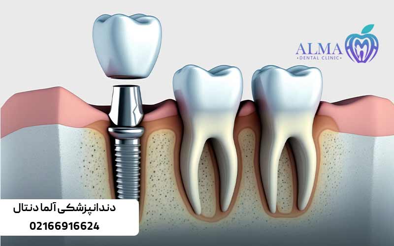 مراحل-انجام-ایمپلنت-دندان