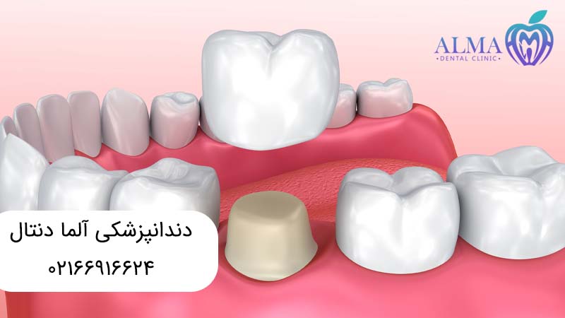 ترمیم تاج دندان