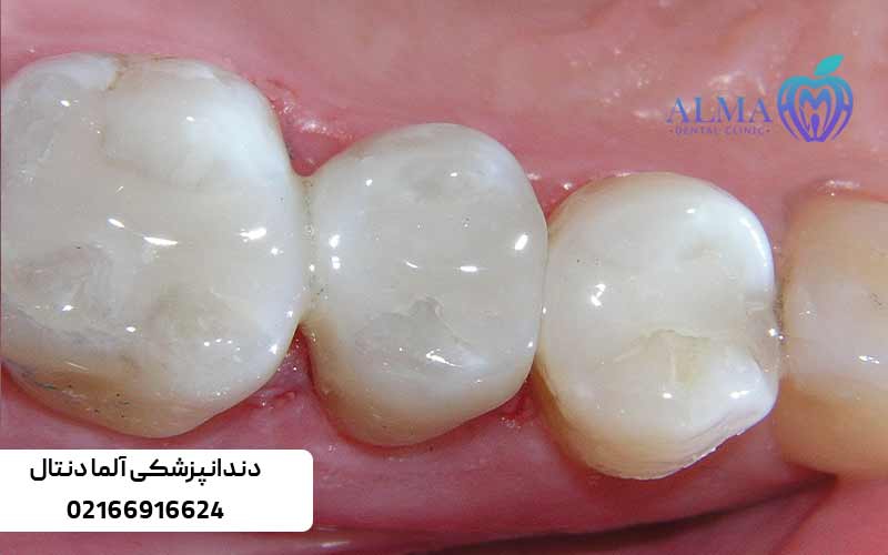 مواد-کامپوزیتی-برای-پر-کردن-دندان