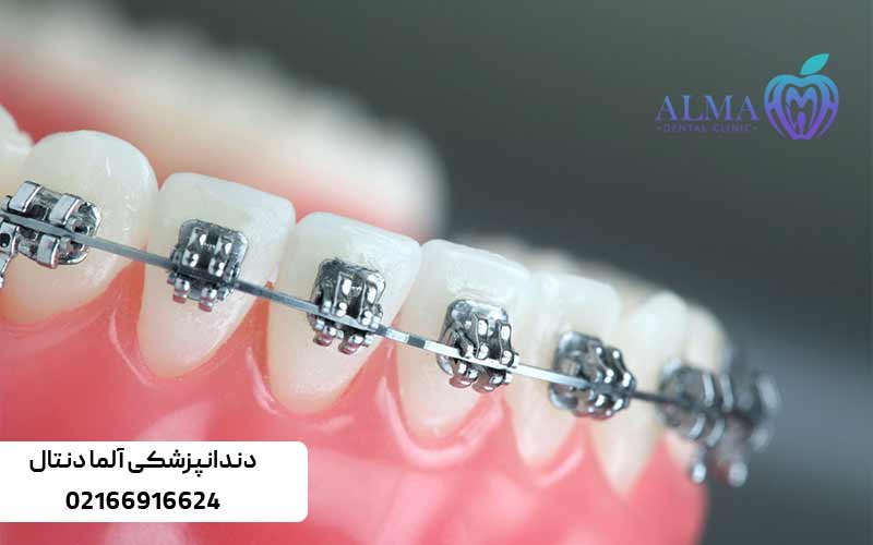 انواع-بریس-دندان