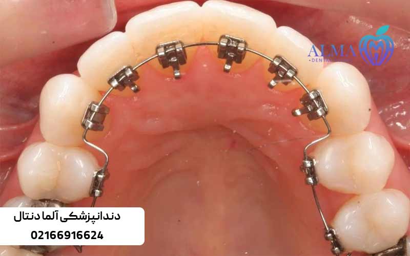 ارتودنسی-پشت-دندانی