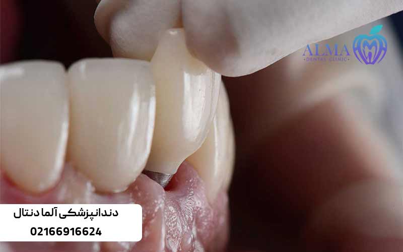 عفونت-ایمپلنت-دندان-و-راه-های-جلوگیری-و-درمان-آن