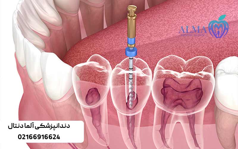 مراحل-عصب-کشی-تخصصی-دندان