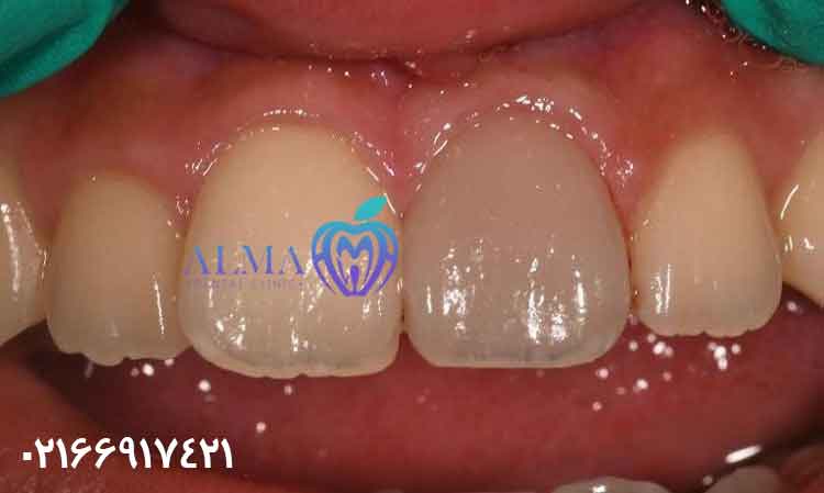 عصب کشی تخصصی دندان