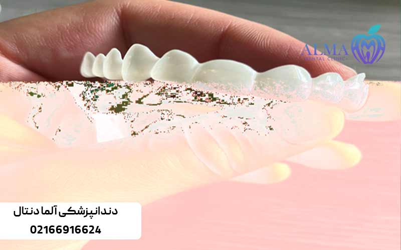 معایب-استفاده-از-لمینت‌های-متحرک-دندان