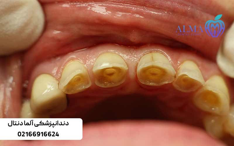 علت-از-بین-رفتن-مینای-دندان-چیست؟