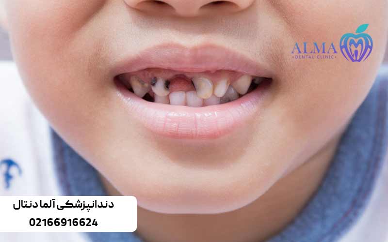 علل-پوسیدگی-دندان-در-کودکان
