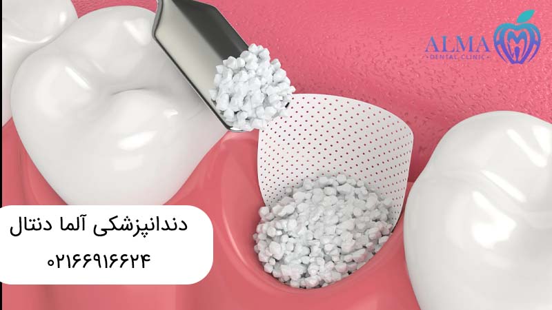 ایمپلنت دندان با پودر استخوان
