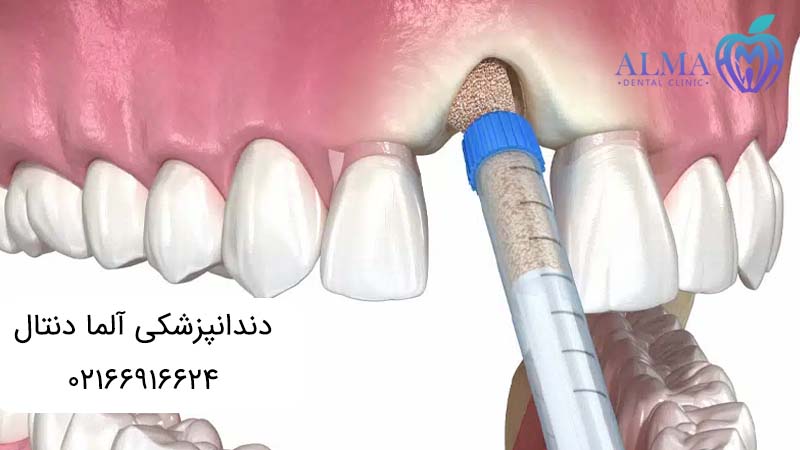 ایمپلنت دندان با پودر استخوان