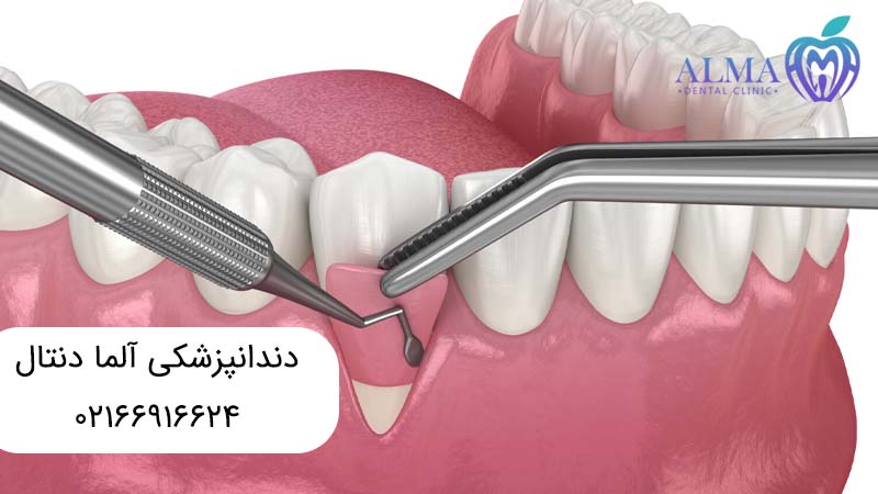 ایمپلنت دندان با پودر استخوان