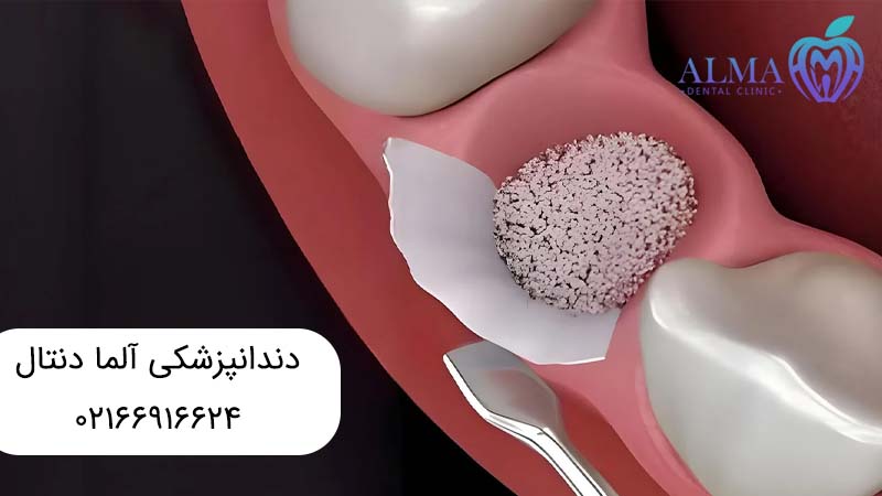 ایمپلنت دندان با پودر استخوان