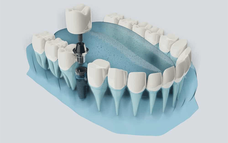 ایمپلنت-دندان-با-روش-دیجیتال