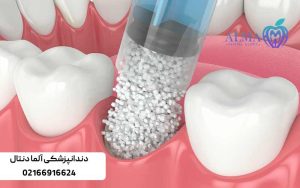 ایمپلنت-دندان-با-پودر-استخوان