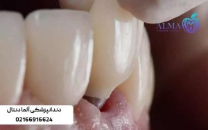 ایمپلنت-دندان-برای-بیماران-قلبی