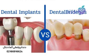 مقایسه-ایمپلنت-و-بریج-دندان