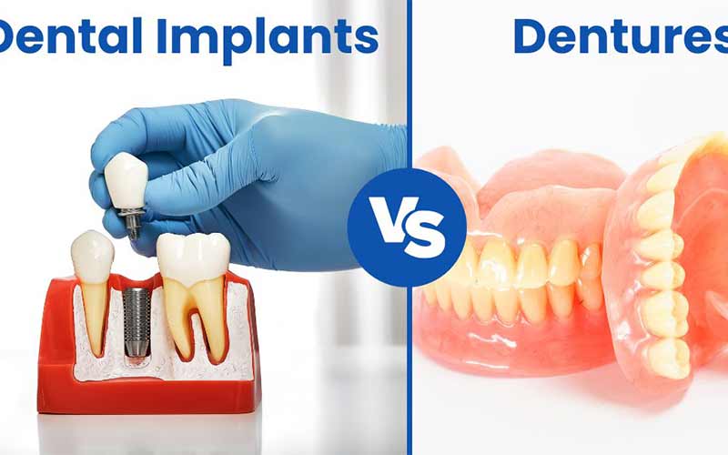 مقایسه-ایمپلنت-و-دندان-مصنوعی