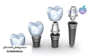 ایمپلنت-دندان-با-بیمه
