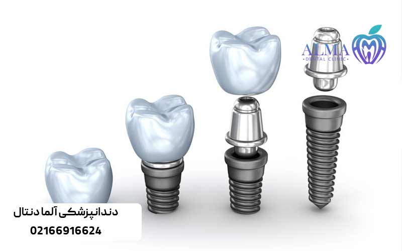 ایمپلنت-دندان-با-بیمه