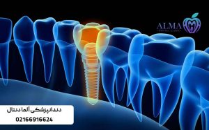 عوارض-ایمپلنت-دندان