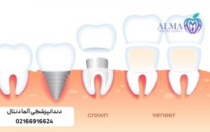 بهترین روشهای جایگزینی دندان