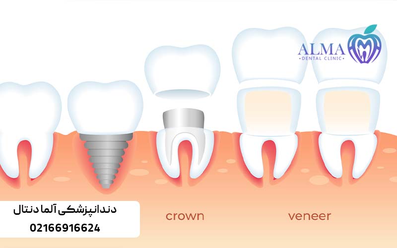 بهترین روشهای جایگزینی دندان