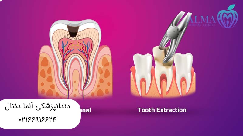 عصب کشی یا کشیدن دندان