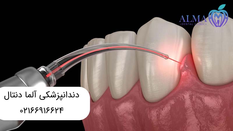 ایمپلنت دندان با لیزر