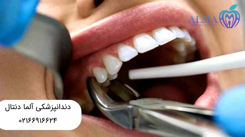 عصب کشی یا کشیدن دندان