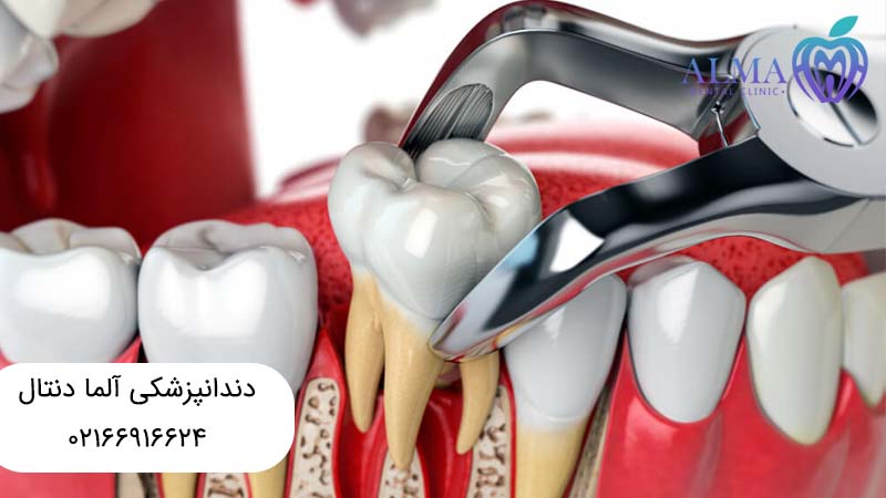 عصب کشی یا کشیدن دندان