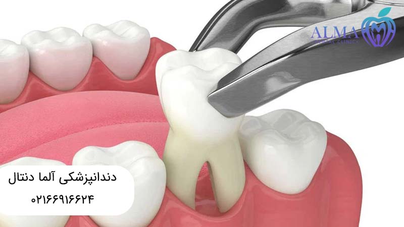 عصب کشی یا کشیدن دندان