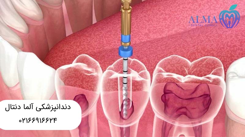 عصب کشی یا کشیدن دندان