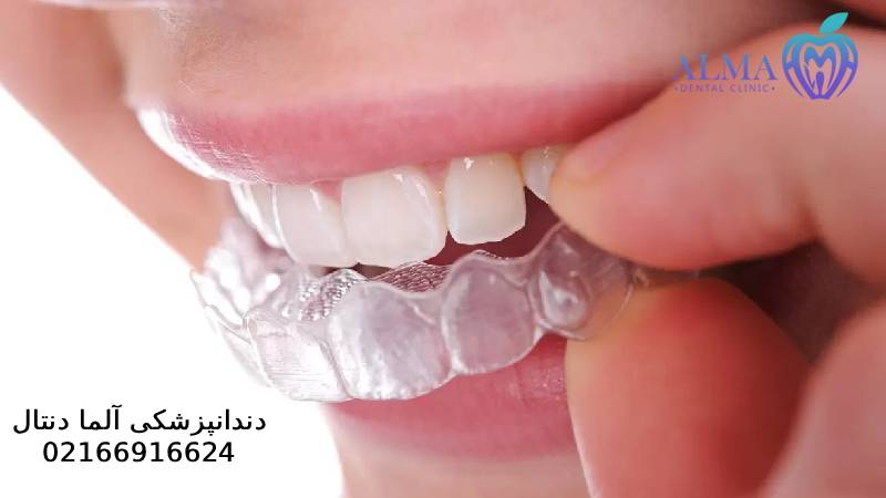 مزایا و معایب ارتودنسی متحرک