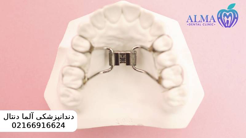 مزایا و معایب ارتودنسی متحرک