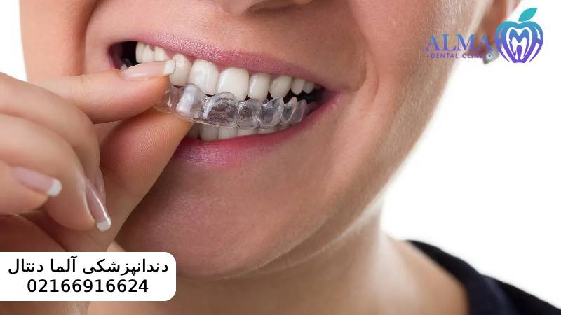 مزایا و معایب ارتودنسی متحرک