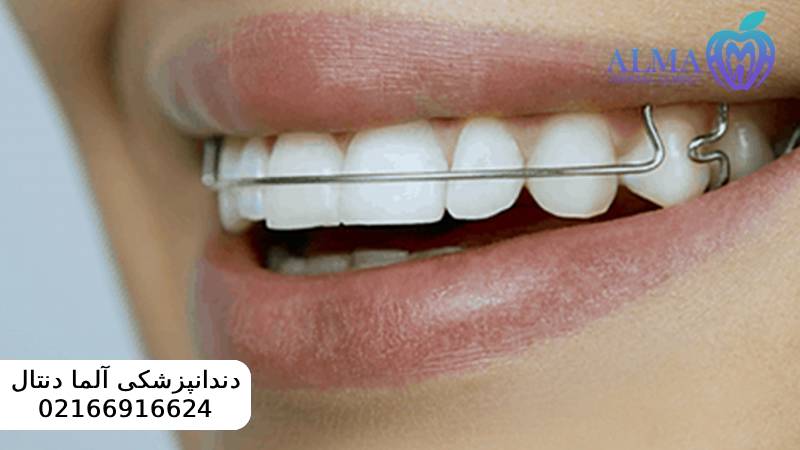 مزایا و معایب ارتودنسی متحرک