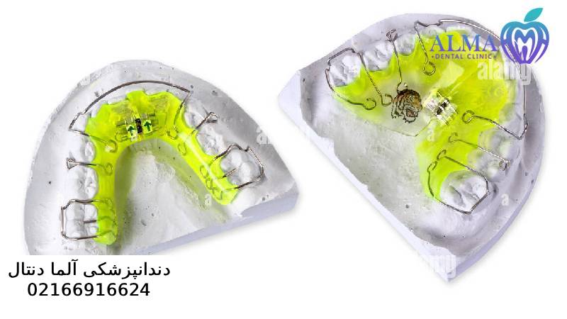 مزایا و معایب ارتودنسی متحرک