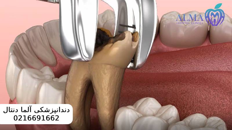 کشیدن ریشه دندان عفونی