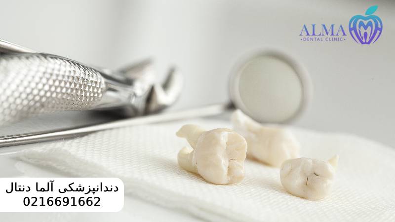کشیدن ریشه دندان عفونی