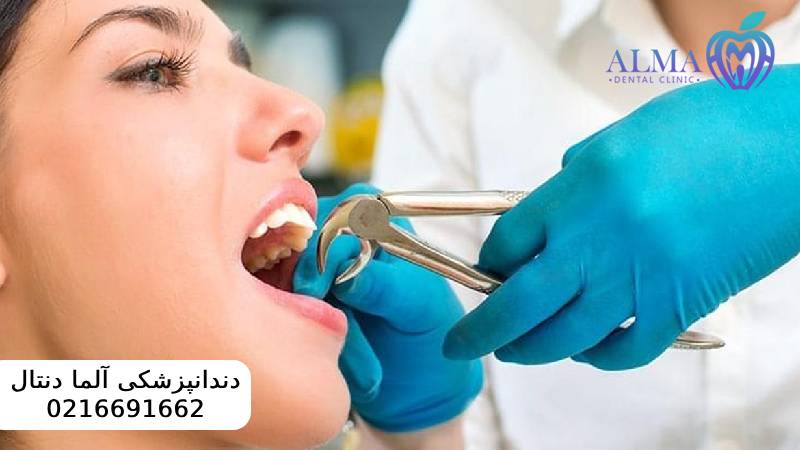 کشیدن ریشه دندان عفونی