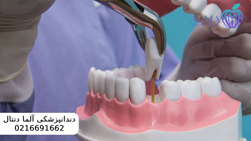کشیدن ریشه دندان عفونی