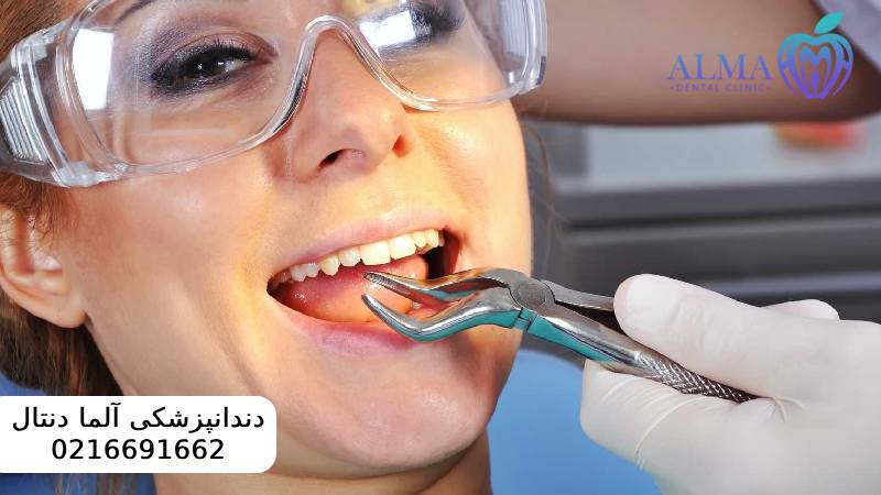 کشیدن ریشه دندان عفونی